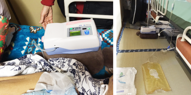 腹膜透析